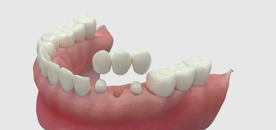 Crescent Family And Cosmetic Dentistry |Sumter, SC | Dental Bridges
