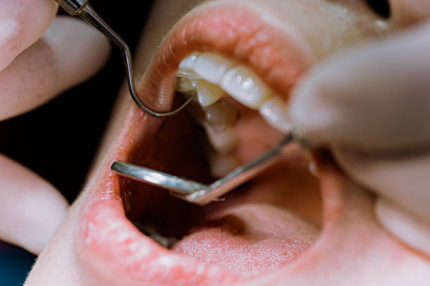 close up Asian Chinese female patient open mouth for dentist examining her tooth routine check up