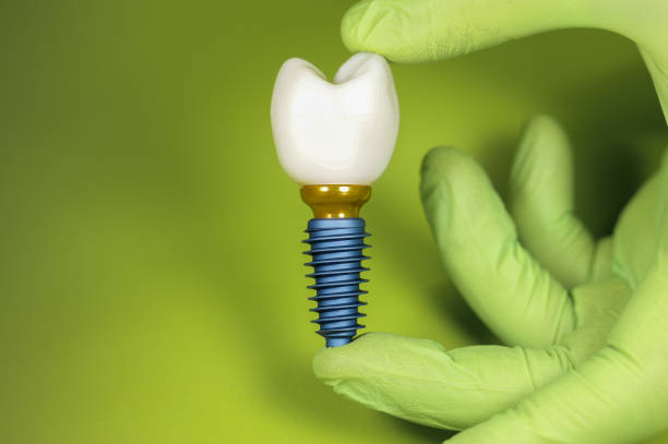 dental-implants