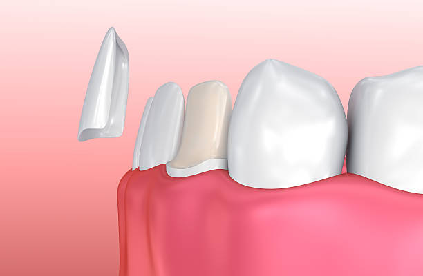 Porcelain-Veneers