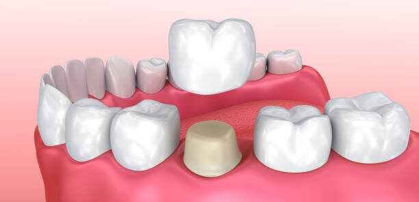 Dental crowns installation process,