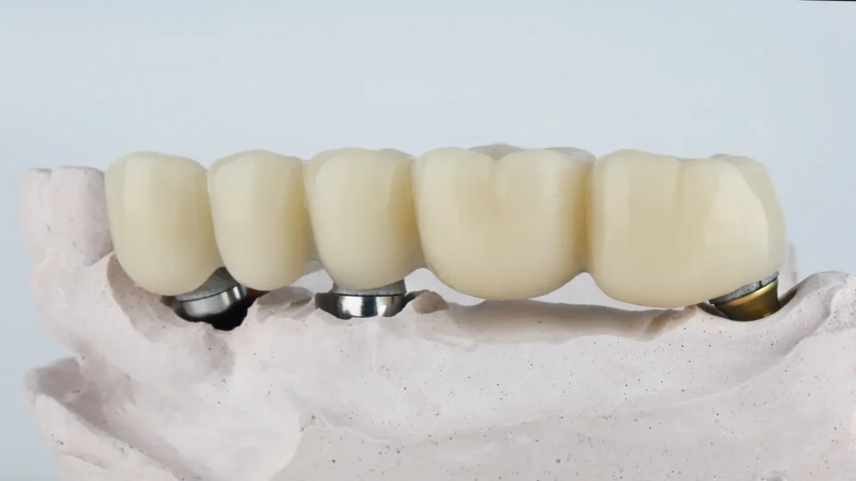Dental Bridges Sumter, SC